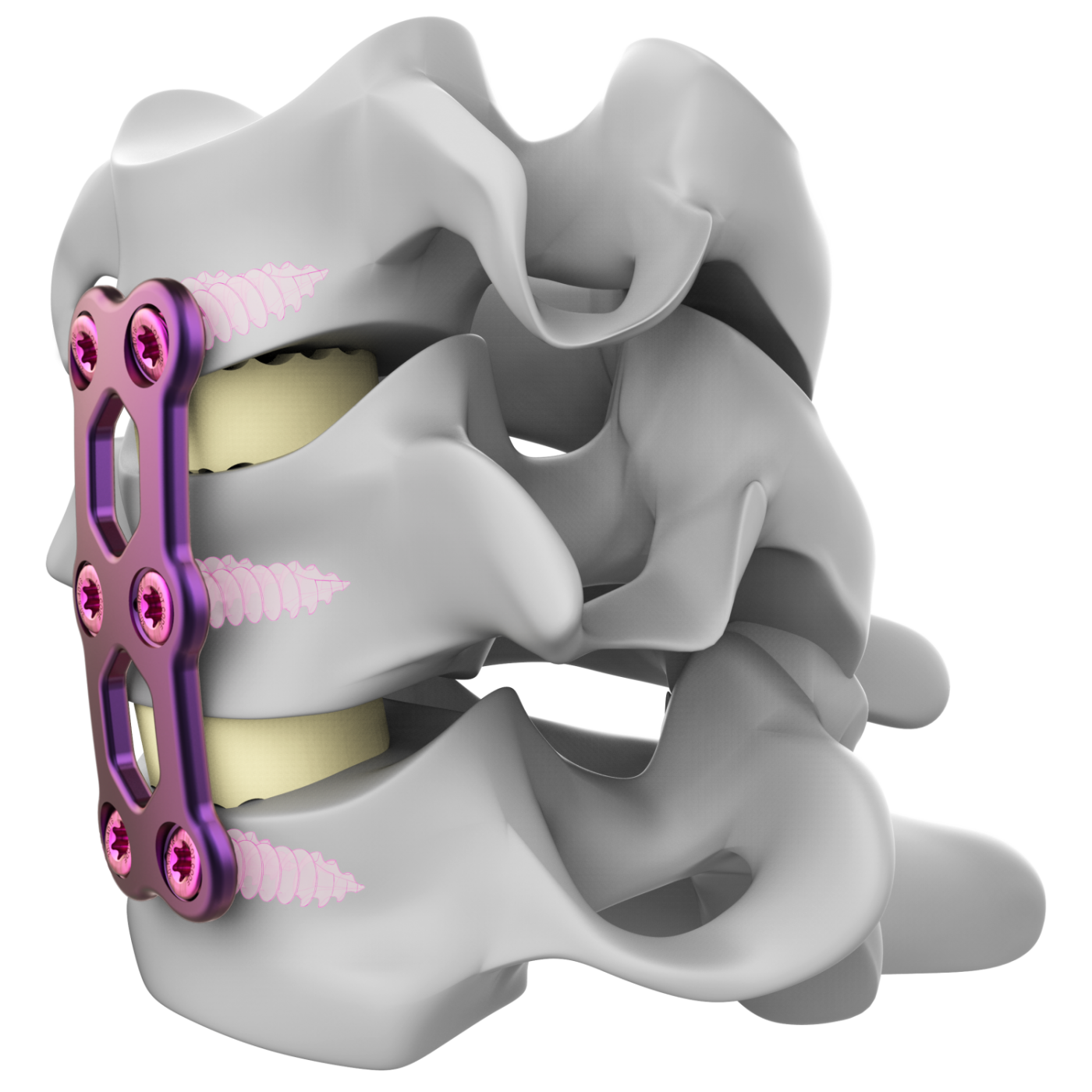 Anterior Cervical Plating Nexxt Spine 1873